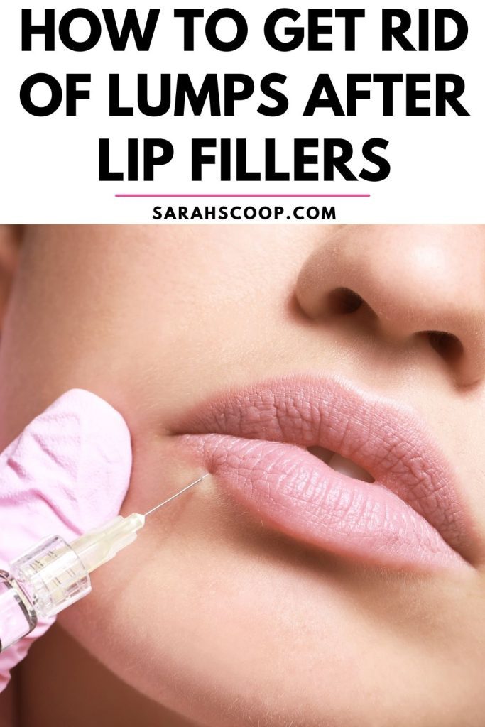 how to get rid of lumps after lip fillers